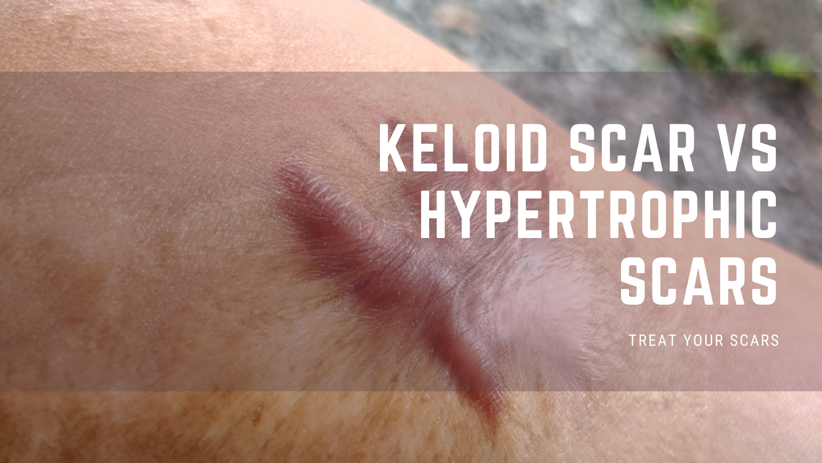Keloid Scar Vs Hypertrophic Scar Treat Your Scars