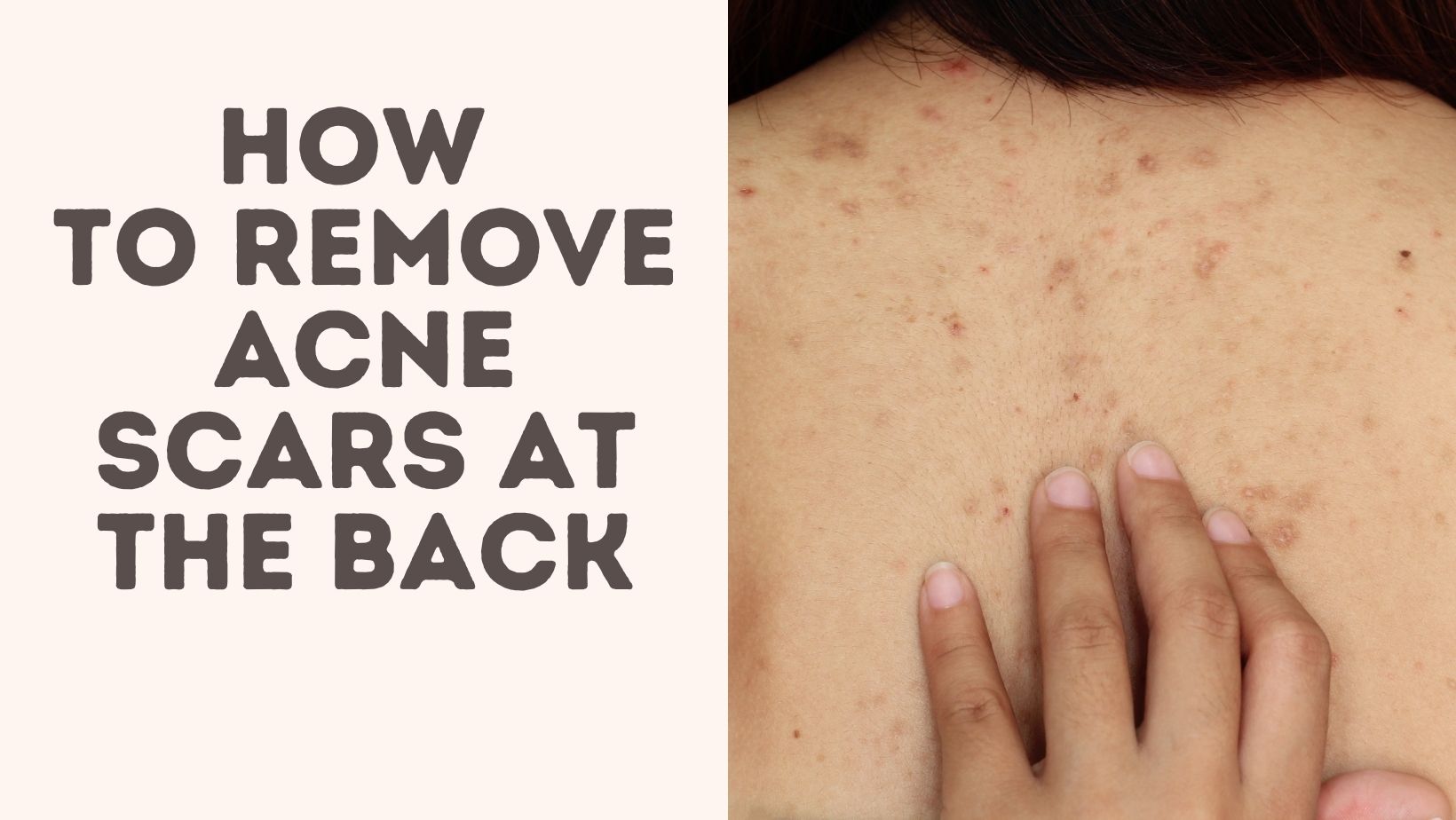 How To Remove Acne Scars At The Back Treat Your Scars