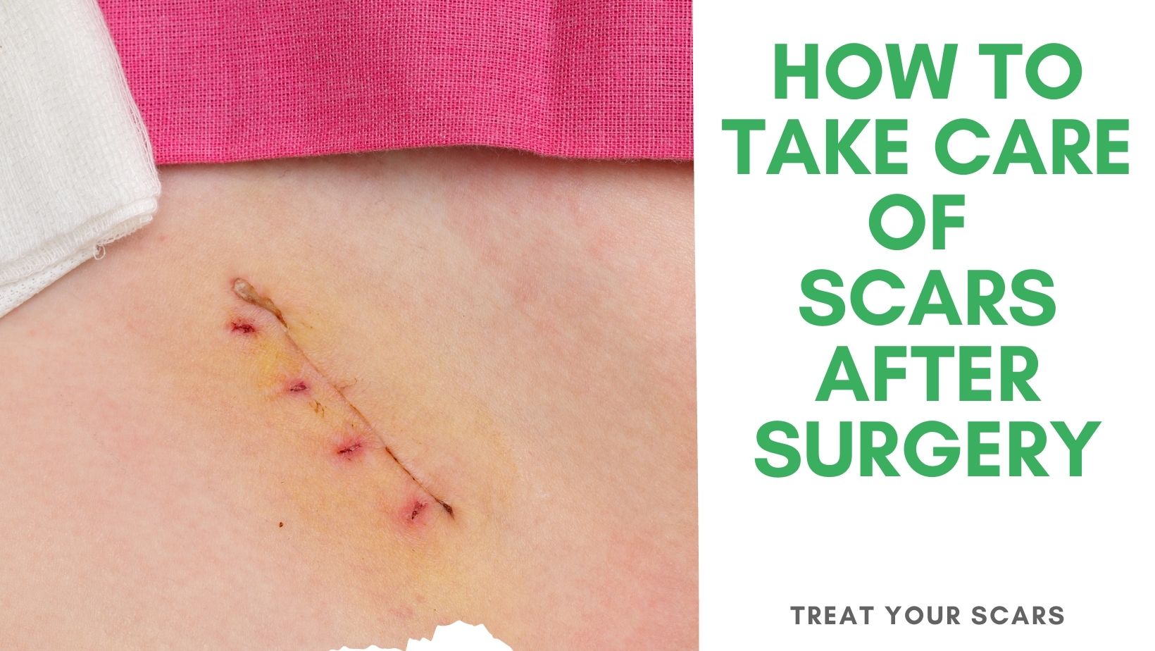 How To Take Care Of Scars After Surgery - Treat Your Scars