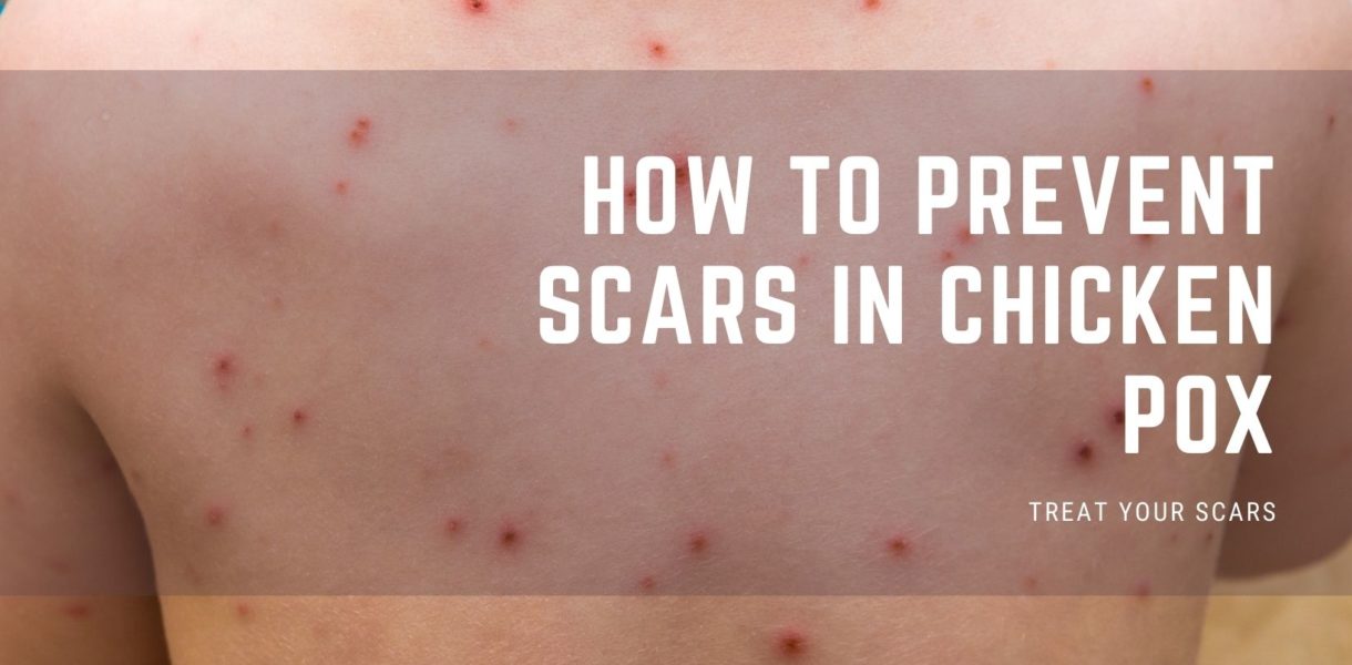 How To Prevent Scars In Chicken Pox Treat Your Scars