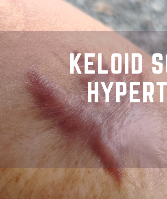 Keloid And Hypertrophic Scars Archives Treat Your Scars