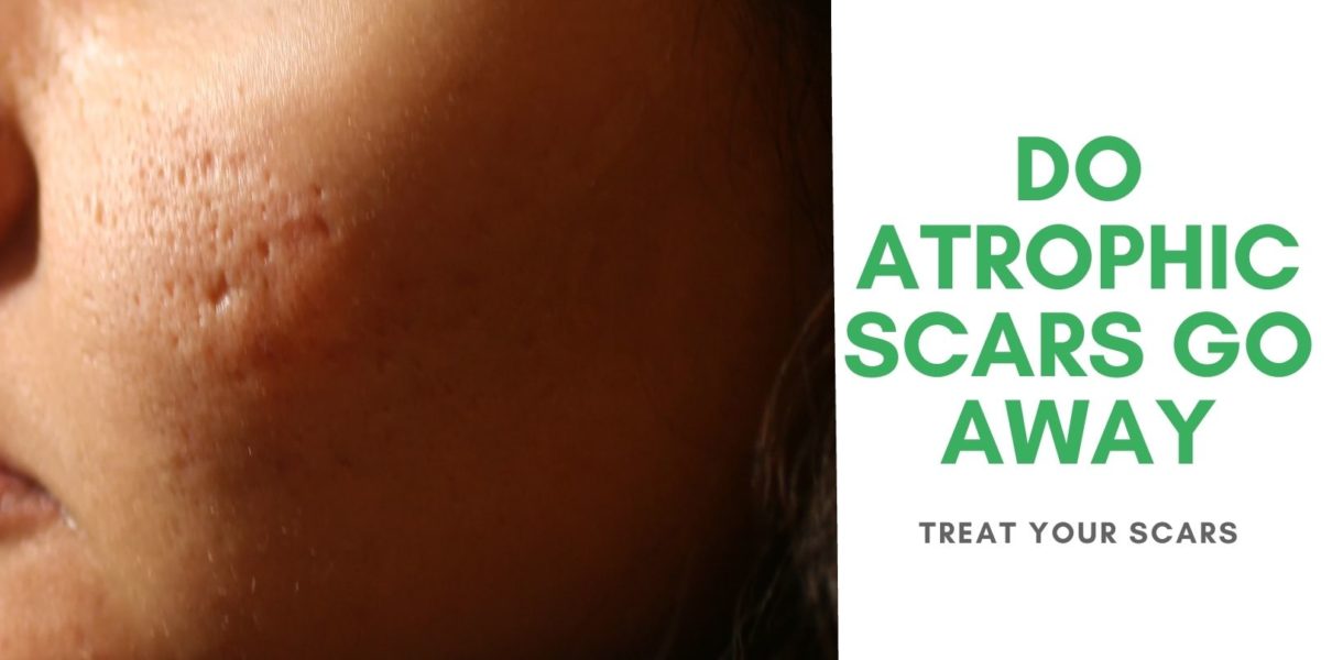 Do Atrophic Scars Go Away Treat Your Scars 5890