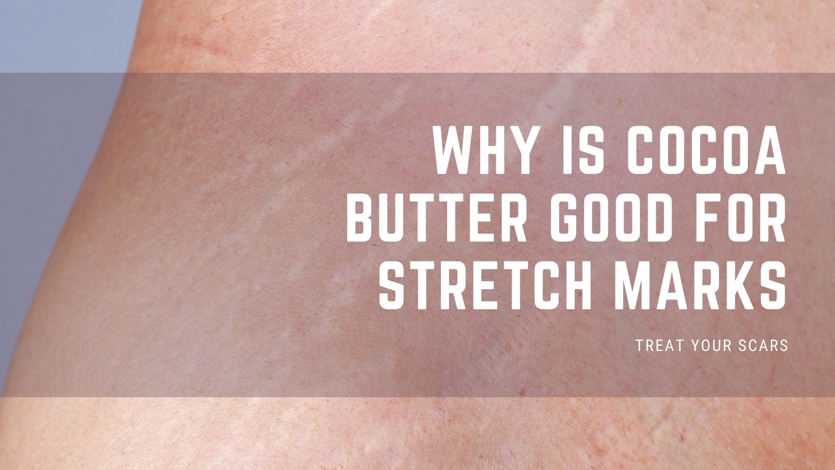 cocoa butter for burn scars