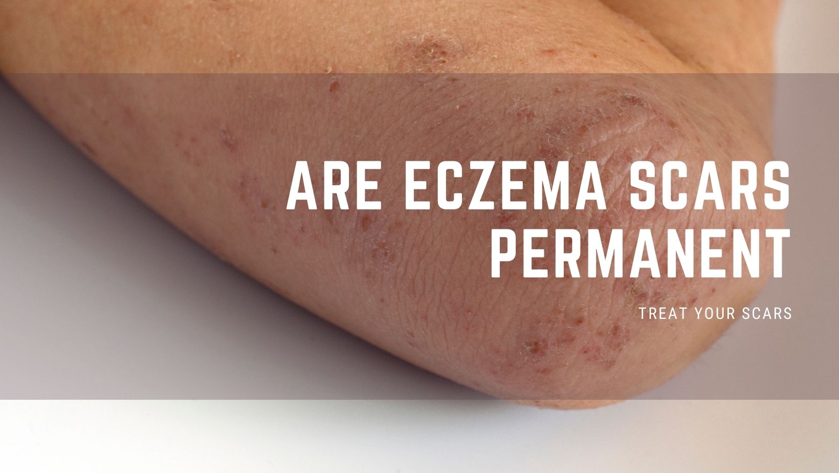 Are Eczema Scars Permanent Treat Your Scars