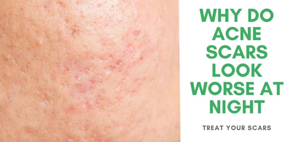 Why Do Acne Scars Look Worse At Night - Treat Your Scars